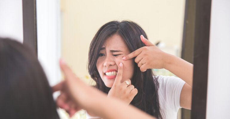 Ways to deal with Hormonal Acne during periods