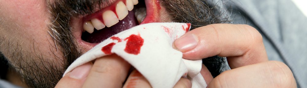 Easy Remedies to Treat Bleeding Gums