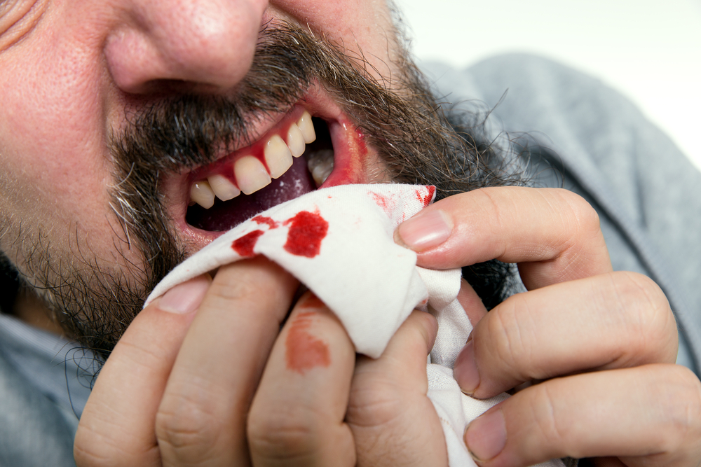 Easy Remedies to Treat Bleeding Gums