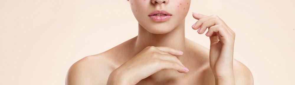 Adult Acne Causes and Remedies
