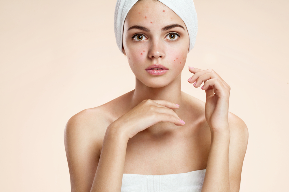 Adult Acne Causes and Remedies