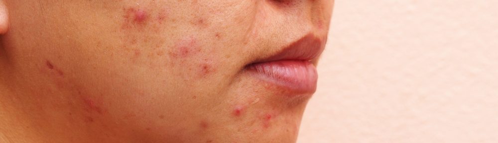 Ways to Fight Pregnancy Acne