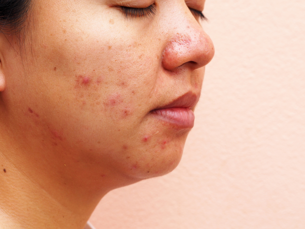 Ways to Fight Pregnancy Acne