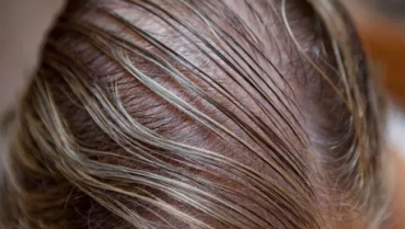 Natural Treatments for Thinning Hair