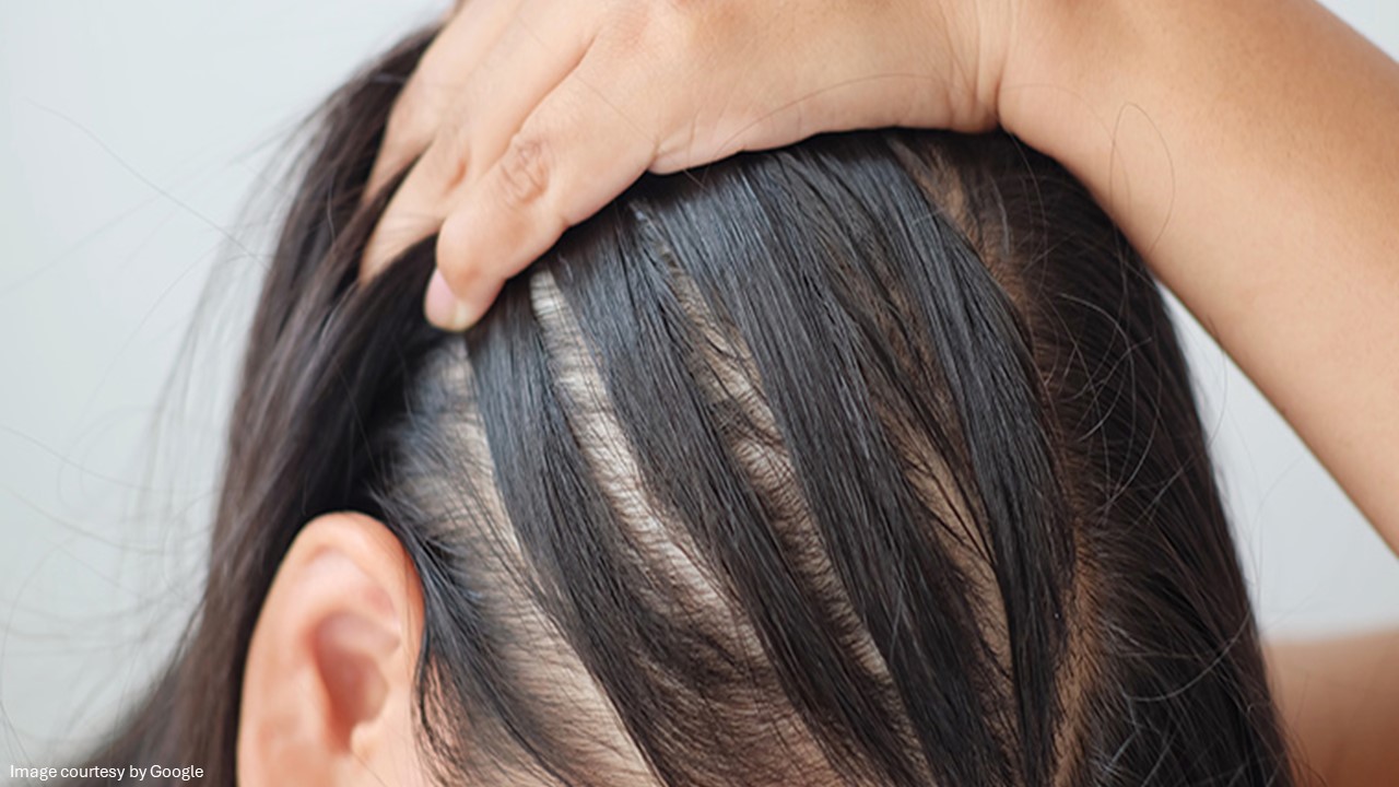 hair loss remedies