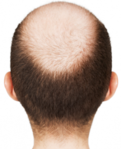 bald hair