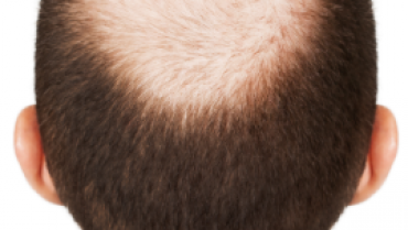 Ways to make Hair Grow Faster when You Have a Bald Spot