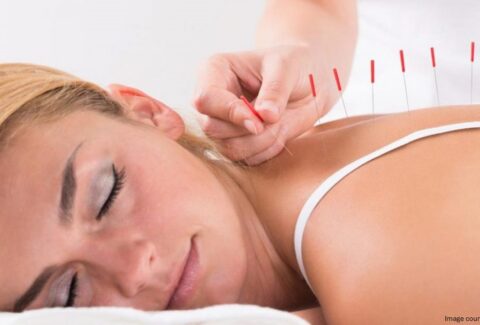 benefits of acupuncture