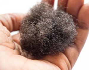 Hair Loss