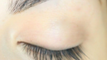 Can Careprost Solution Help Regrow Eyelashes?
