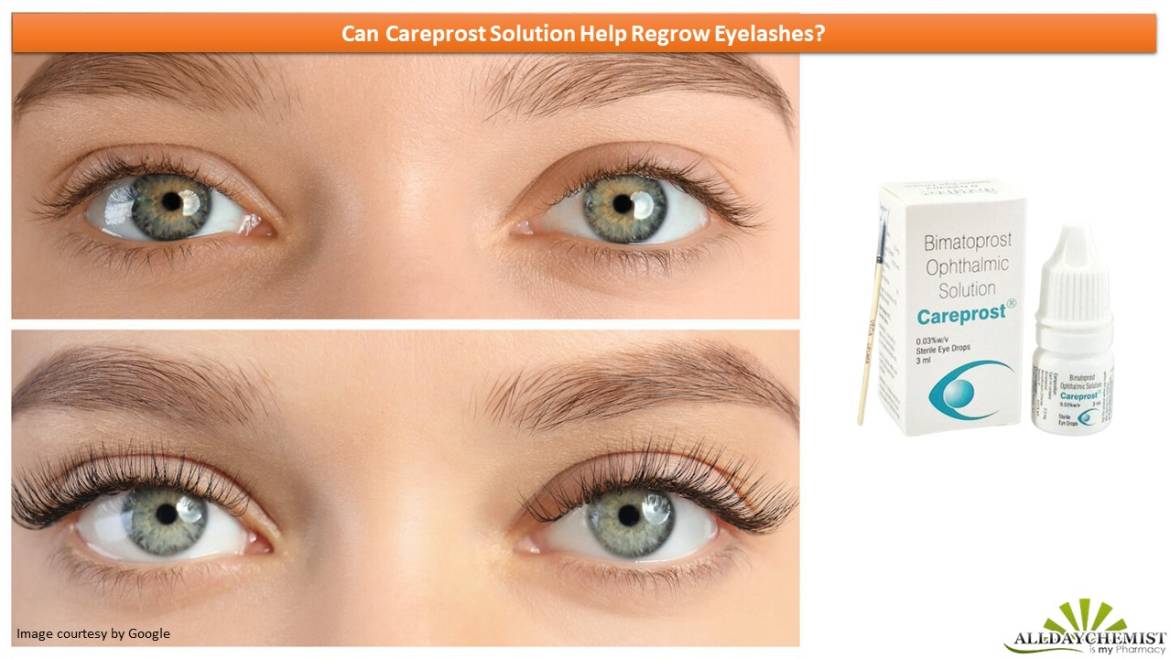 Can Careprost Solution Help Regrow Eyelashes?