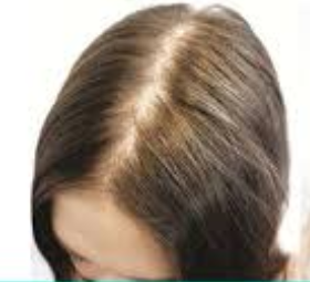 hair loss