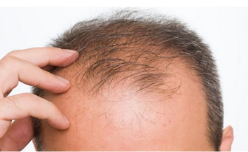 Hair Loss Treatment and Products