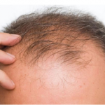 The Best Hair Loss Treatment and Products