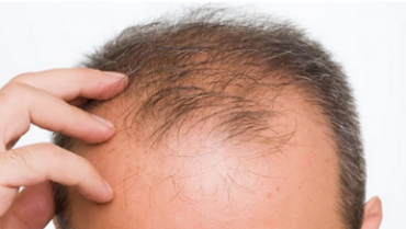 The Best Hair Loss Treatment and Products