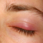 Few Effective Home Remedies For Chalazion