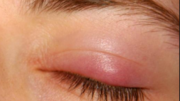 Few Effective Home Remedies For Chalazion