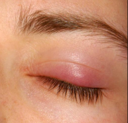 Few Effective Home Remedies For Chalazion