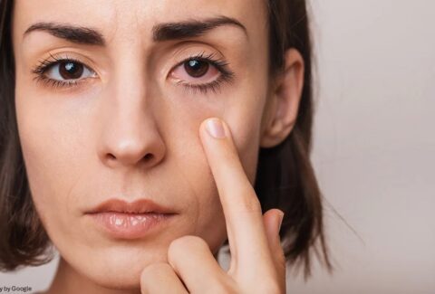 chalazion home remedy - All Day Chemist