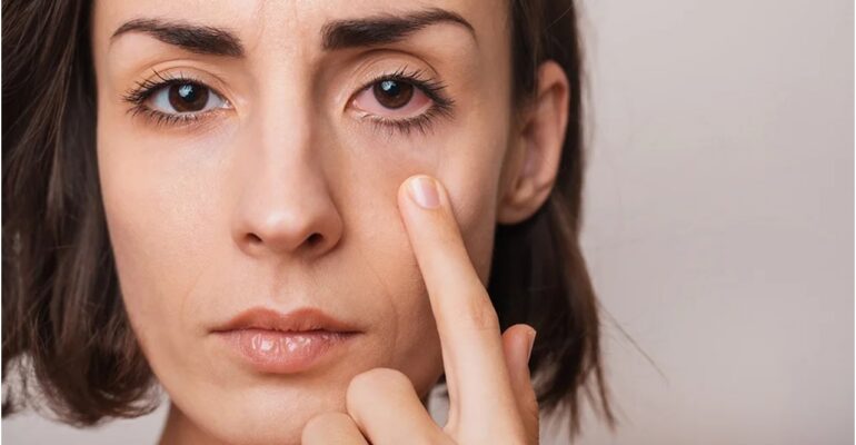 chalazion home remedy - All Day Chemist