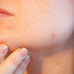 Connection between Oily Skin & Acne