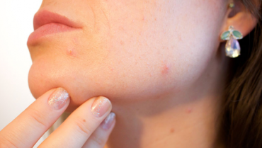 Connection between Oily Skin & Acne