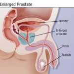 Can an Enlarged Prostate (BPH) Affect Your Bladder?