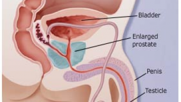 Can an Enlarged Prostate (BPH) Affect Your Bladder?
