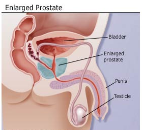 Can an Enlarged Prostate (BPH) Affect Your Bladder?
