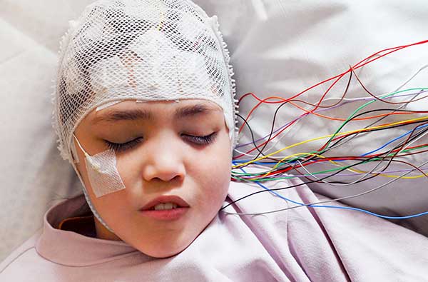 How to Diagnose Epilepsy in Childhood