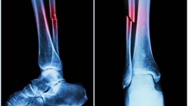 5 Tips to Prevent Bone Fractures