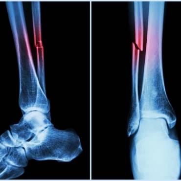 5 Tips to Prevent Bone Fractures