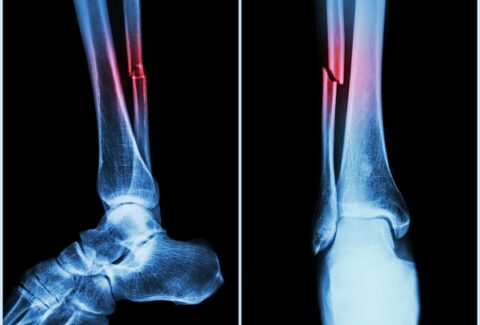 bone fractures