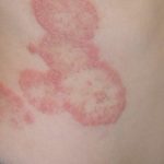 6 Painful Fungal Infections