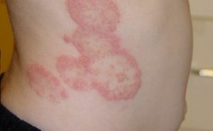 fungal-infection