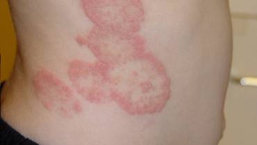 6 Painful Fungal Infections