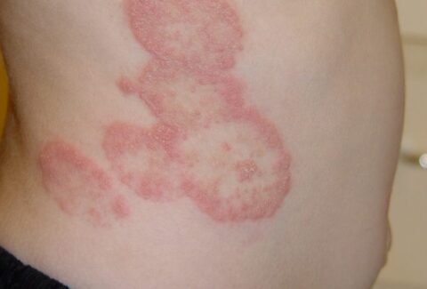 fungal-infection