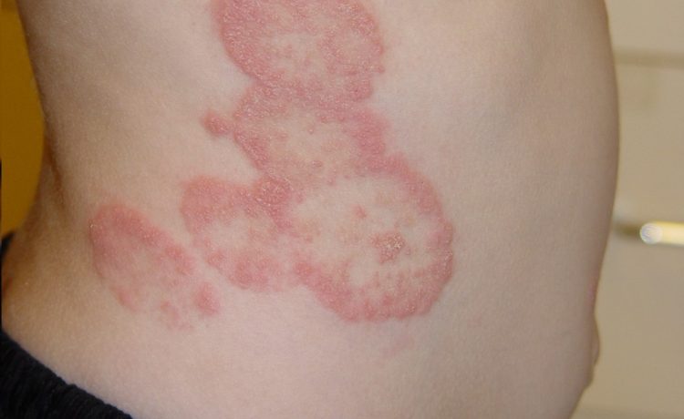6 Painful Fungal Infections
