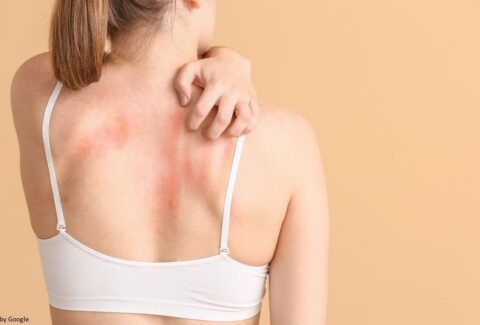 Image of a woman dealing with fungal infection on her skin.