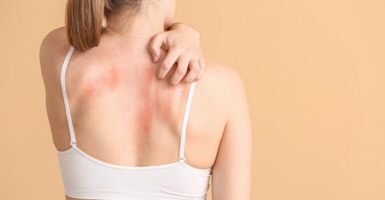 Image of a woman dealing with fungal infection on her skin.