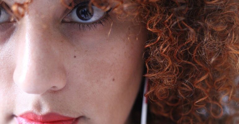 melasma