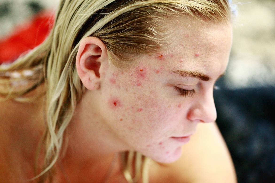 How-Supatret-Gel-Helps-To-Fight-Acne.jpg