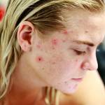 How Supatret Gel Helps To Fight Acne