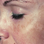 How to Get Rid Of Melasma?