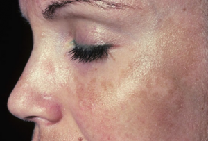 Melasma