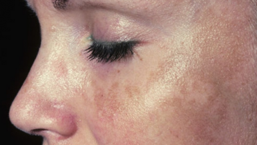 How to Get Rid Of Melasma?