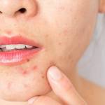 How to Get Rid of Chin Acne?