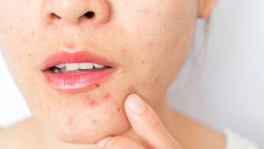 How to Get Rid of Chin Acne?
