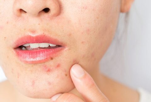How to get rid of chin acne_banner