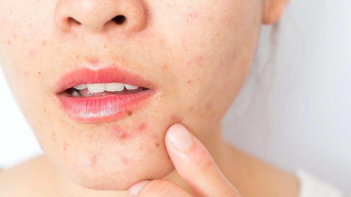 How to Get Rid of Chin Acne?